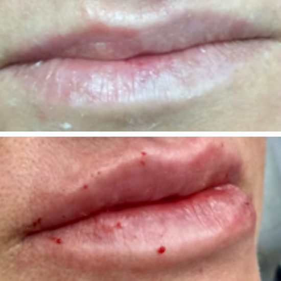 Lip Fillers & Lip Enhancements