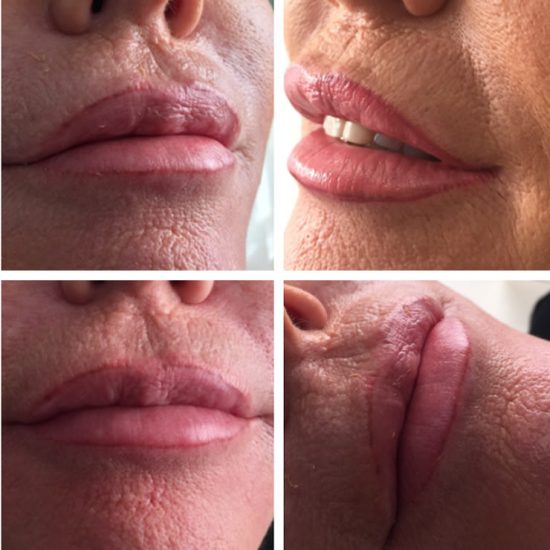 Lip Fillers & Lip Enhancements