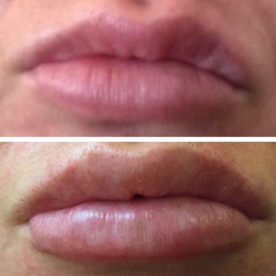 Lip Fillers & Lip Enhancements