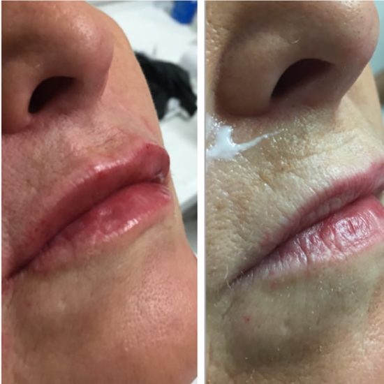 Lip Fillers & Lip Enhancements