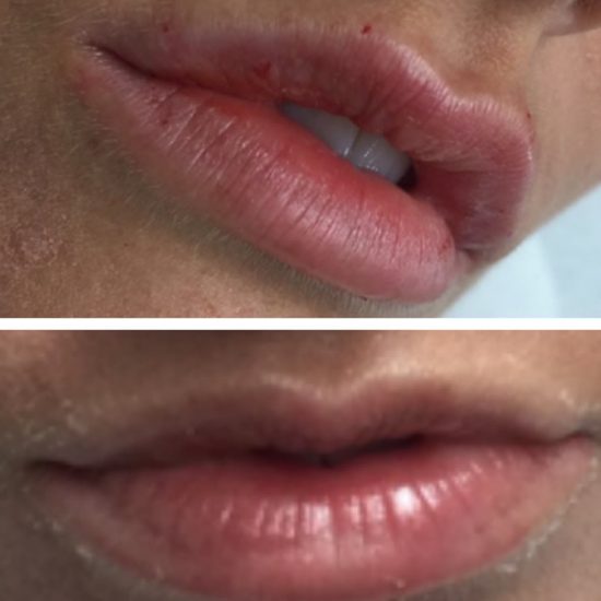 Lip Fillers & Lip Enhancements