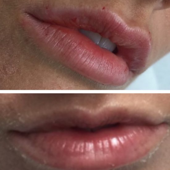 Lip Fillers & Lip Enhancements