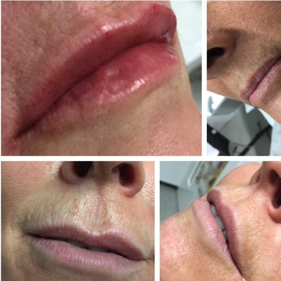 Lip Fillers & Lip Enhancements