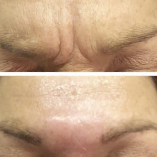 Botox Anti Wrinkle Treatment