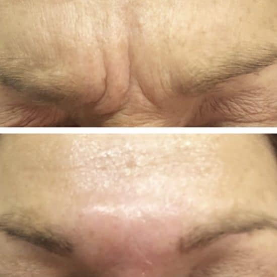 Botox Anti Wrinkle Treatment