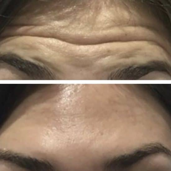 Botox Anti Wrinkle Injections