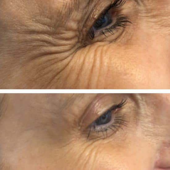 Botox Anti Wrinkle Treatment