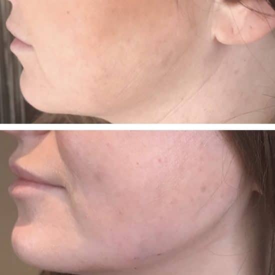 Jaw Contouring