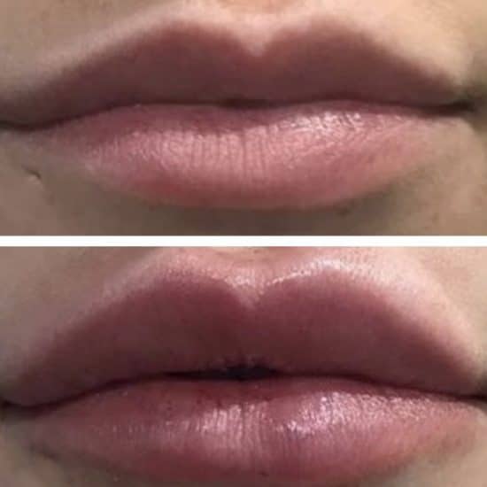 Lip Fillers & Lip Enhancement