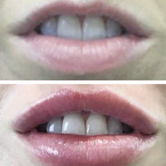 Lip Fillers & Lip Enhancement