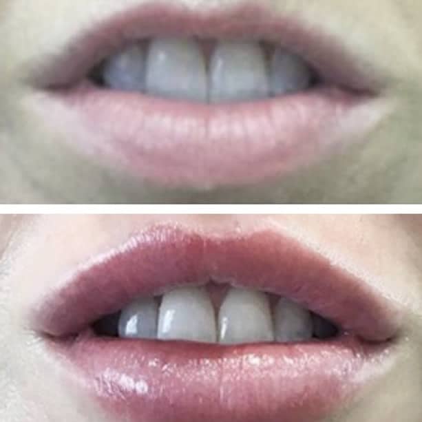 Lip Fillers & Lip Enhancement