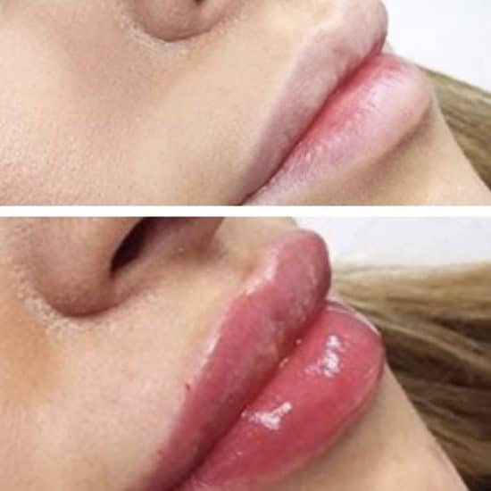 Lip Fillers & Lip Enhancements