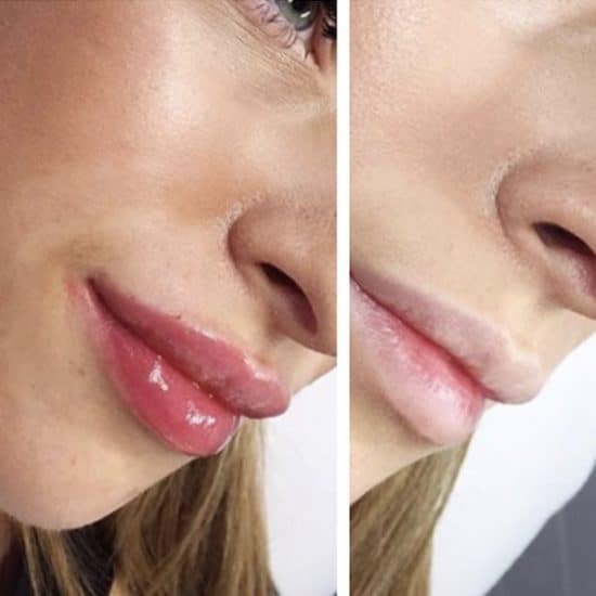 Lip Fillers & Lip Enhancements