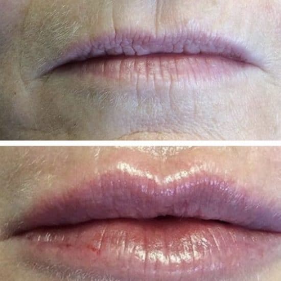 Lip Fillers & Lip Enhancements