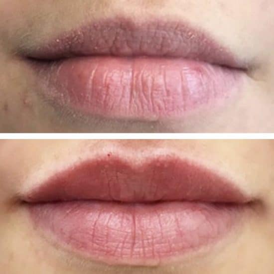 Lip Fillers & Lip Enhancements