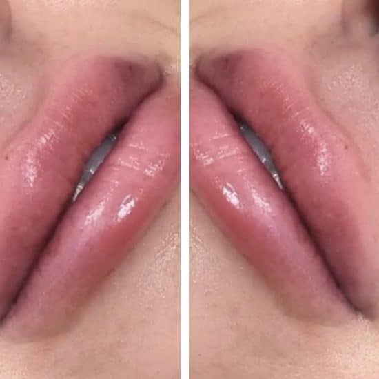 Lip Fillers & Lip Enhancements