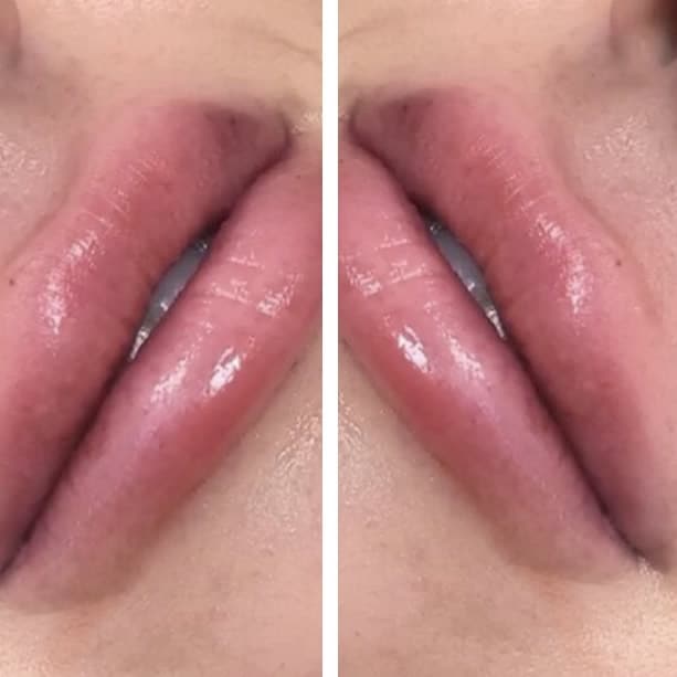 Lip Fillers & Lip Enhancements
