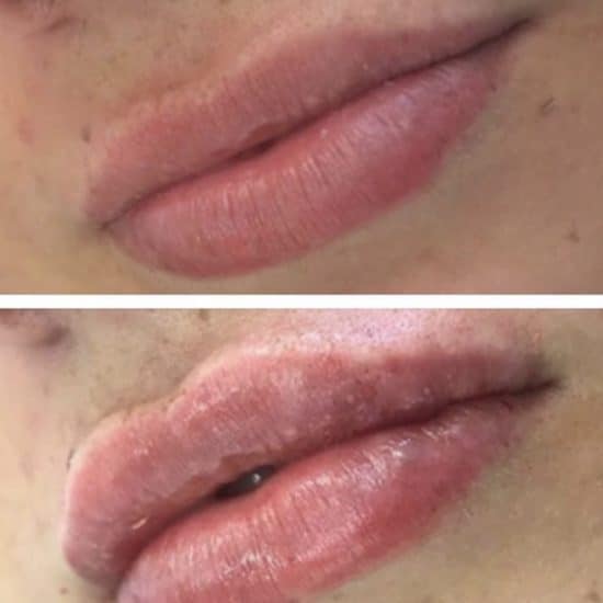 Lip Fillers & Lip Enhancements