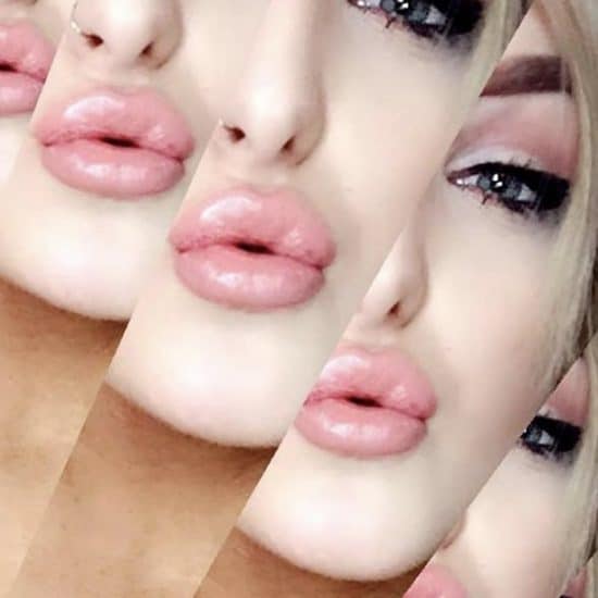 Lip Fillers & Lip Enhancements