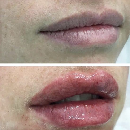 Lip Fillers & Lip Enhancements