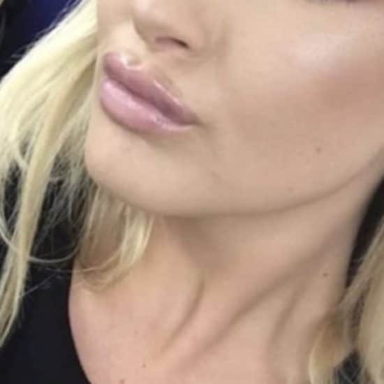 Lip Fillers & Lip Enhancements