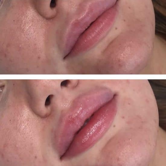 Lip Fillers & Lip Enhancements