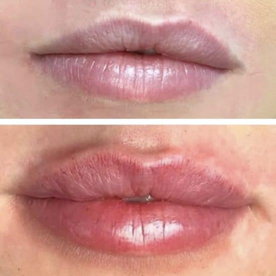 Lip Fillers & Lip Enhancement