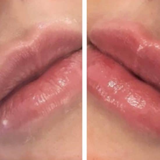 Lip Fillers & Lip Enhancement