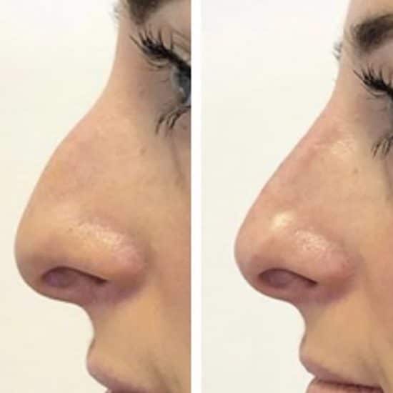 Rhinoplasty