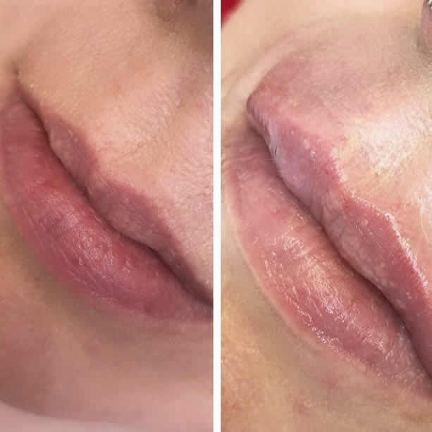 Lip Fillers & Lip Enhancement
