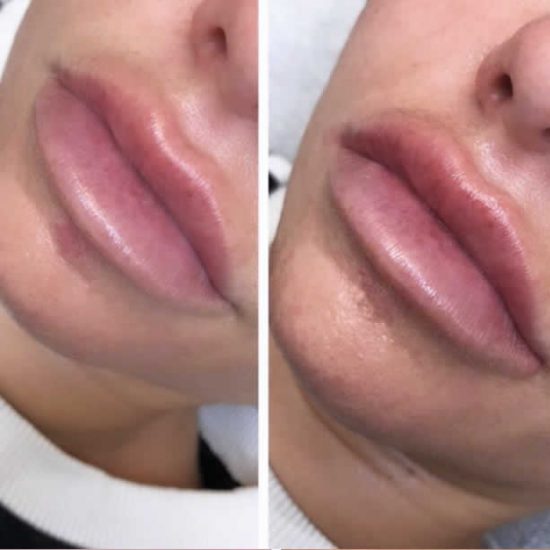 Lip Fillers & Lip Enhancement