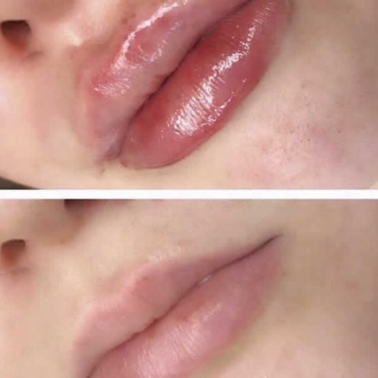 Lip Fillers & Lip Enhancement