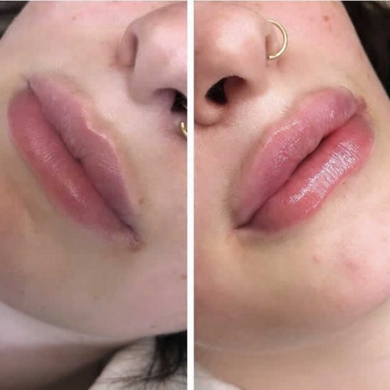 Lip Fillers & Lip Enhancement