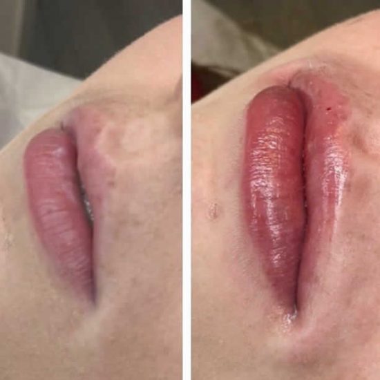 Lip Fillers & Lip Enhancement