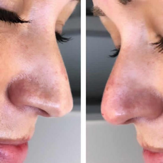 rhinoplasty-sept19-1