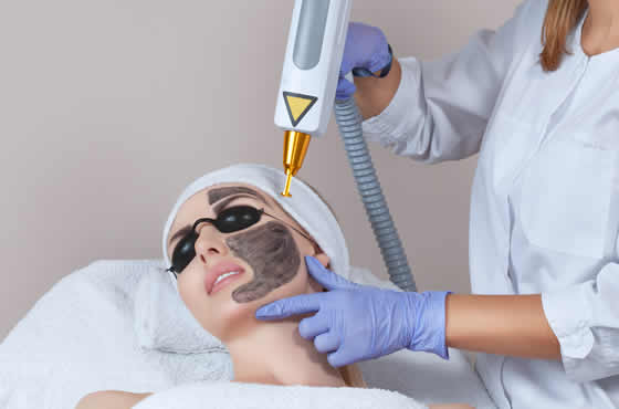 carbon-laser-peel1