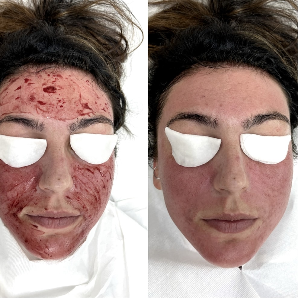 collagen-induction-therapy-treatment1