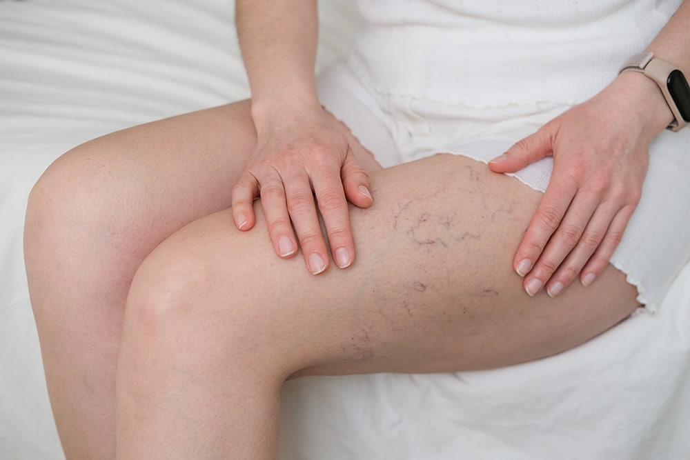 Woman sits on a bed, placing her hands near visible spider veins on her thigh. Ideal for medical, aesthetic and wellness content regarding vascular health and skin conditions