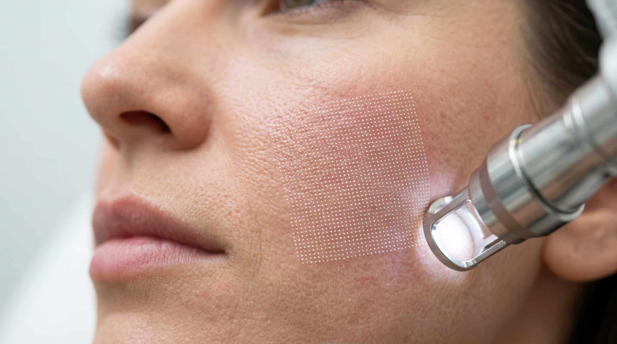 Fractional CO₂ Laser & Microneedling: Why They're the Ultimate Power Couple for Skin Rejuvenation Fractional CO₂ Laser & Microneedling: Why They're the Ultimate Power Couple for Skin Rejuvenation